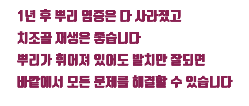 [보람있는 치료] 휘어진 뿌리 + 기둥까지 박힌 치아의 성공적인 치료 #재식술 #치아재식술 #최용훈원장 사진 6