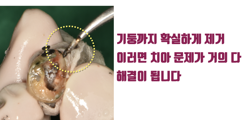 [보람있는 치료] 휘어진 뿌리 + 기둥까지 박힌 치아의 성공적인 치료 #재식술 #치아재식술 #최용훈원장 사진 4