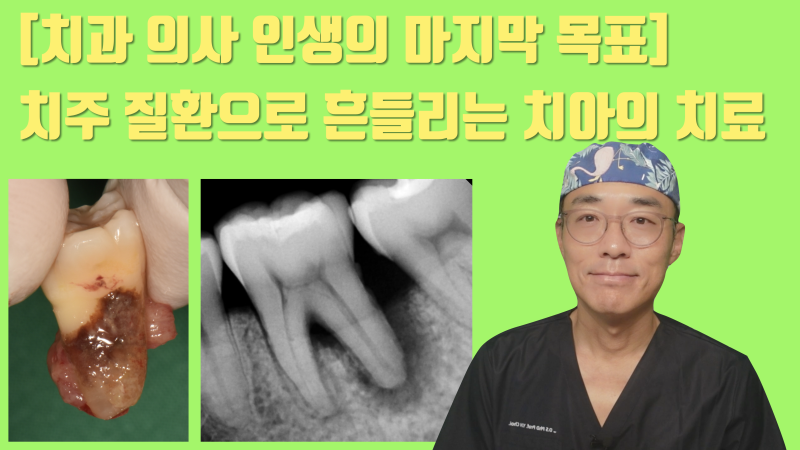 [역사적인 치아 살리기] 치석과 세균으로 발치 판정 받은 치아를 살리는 과정 #재식술 #치아살리기 #최용훈원장