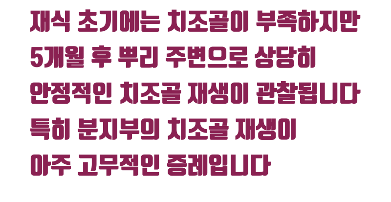 [역사적인 치아 살리기] 치석과 세균으로 발치 판정 받은 치아를 살리는 과정 #재식술 #치아살리기 #최용훈원장 사진 6