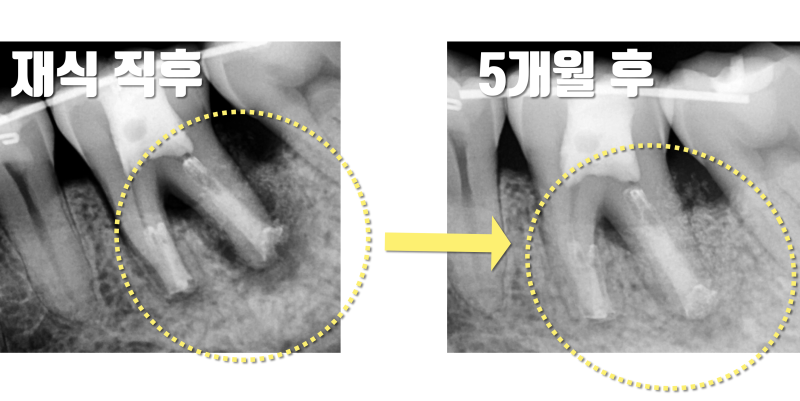 [역사적인 치아 살리기] 치석과 세균으로 발치 판정 받은 치아를 살리는 과정 #재식술 #치아살리기 #최용훈원장 사진 5