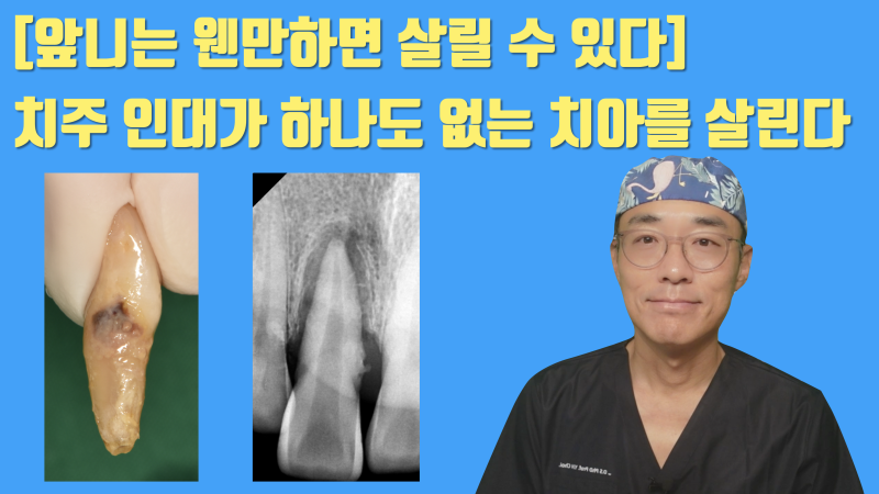 [역사적인 치아 살리기] 앞니는 어떻게든 살려볼 기회가 많습니다 #치주질환재식술 #재식술 #최용훈원장