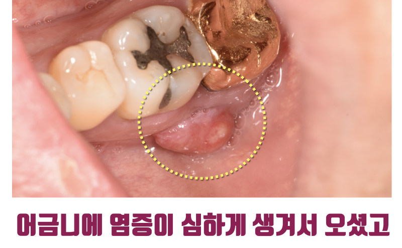 [환자도 의사도 X쳐야 하는 증례] 독일에서 치아 살리러 날라온 환자 스토리 #파절치재식술 #재식술 #최용훈원장 사진 2