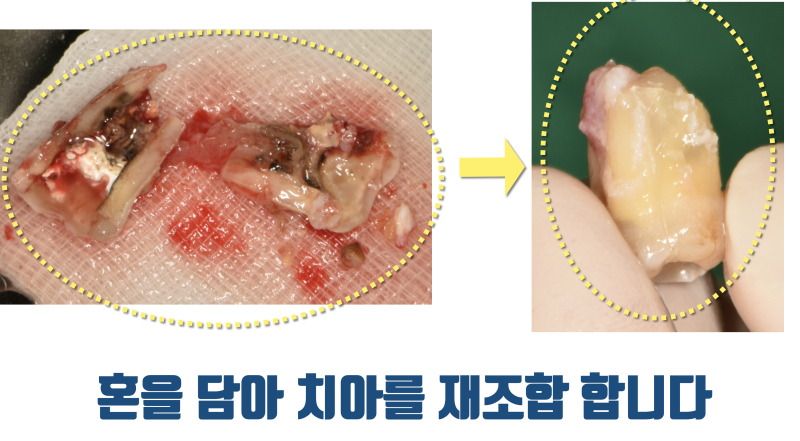 [환자도 의사도 X쳐야 하는 증례] 독일에서 치아 살리러 날라온 환자 스토리 #파절치재식술 #재식술 #최용훈원장