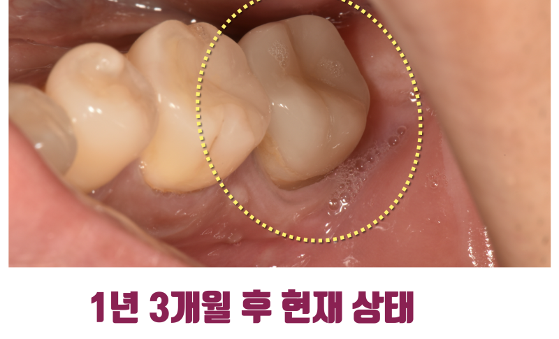 [환자도 의사도 X쳐야 하는 증례] 독일에서 치아 살리러 날라온 환자 스토리 #파절치재식술 #재식술 #최용훈원장 사진 7