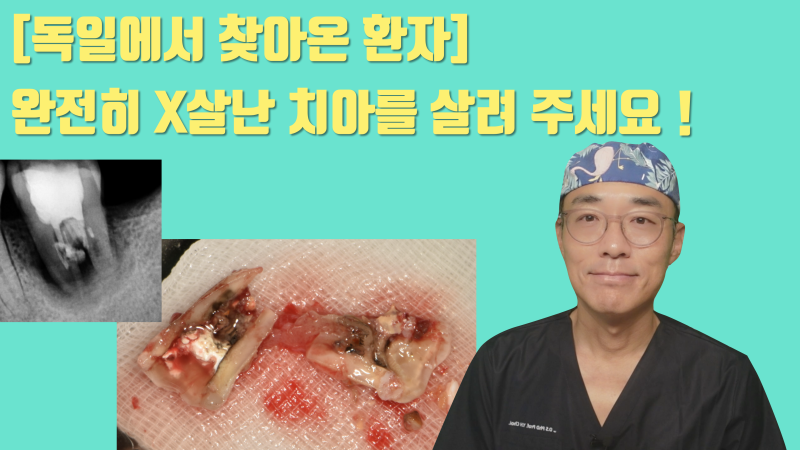 [환자도 의사도 X쳐야 하는 증례] 독일에서 치아 살리러 날라온 환자 스토리 #파절치재식술 #재식술 #최용훈원장