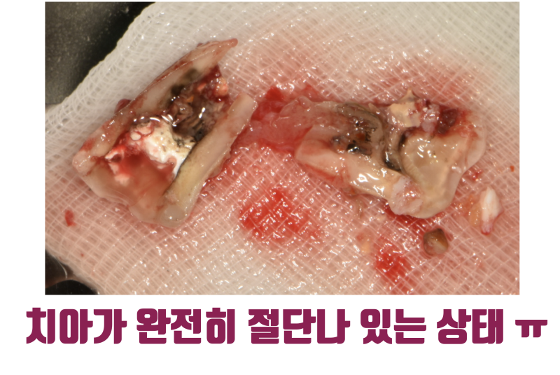 [환자도 의사도 X쳐야 하는 증례] 독일에서 치아 살리러 날라온 환자 스토리 #파절치재식술 #재식술 #최용훈원장 사진 4