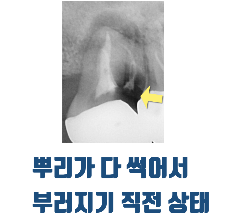 [하고 나서 놀란 치료] 신이시여 제가 이 치아를 안 부서지게 뽑았습니까 ? #재식술 #치아살리기 #최용훈원장 사진 2
