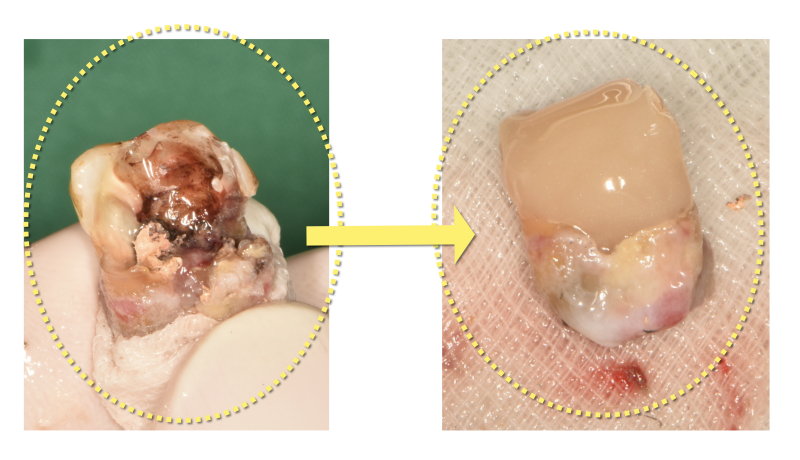 [하고 나서 놀란 치료] 신이시여 제가 이 치아를 안 부서지게 뽑았습니까 ? #재식술 #치아살리기 #최용훈원장