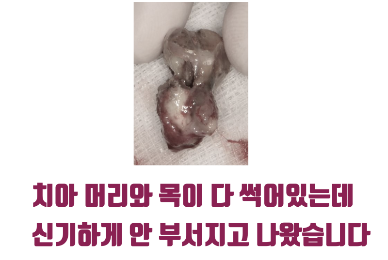 [하고 나서 놀란 치료] 신이시여 제가 이 치아를 안 부서지게 뽑았습니까 ? #재식술 #치아살리기 #최용훈원장 사진 3