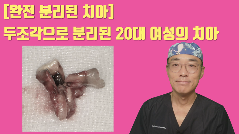 [완전 파절 치아 살리기] 두동강난 치아의 치료 1년 3개월 경과 #재식술 #파절치아 #최용훈원장
