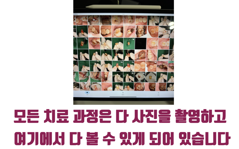 진료 과정 사진을 누구나 볼 수 있게 오픈하는 이유 #재식술 #치아살리기 #최용훈원장