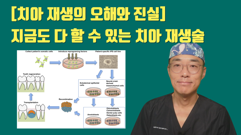 [치아 재생의 오해와 진실] 기다릴 필요도 없이 지금도 할 수 있는 치아 재생술 #재식술 #치아이식 #최용훈원장