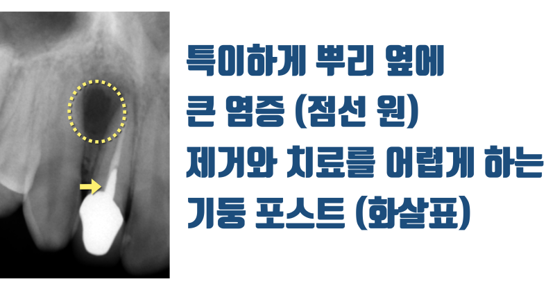 [오래 쓰는 자연 치아] 앞니 재식술 11년 경과 증례를 소개합니다 #재식술 #치아살리기 #최용훈원장 사진 2