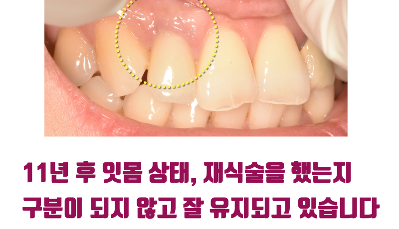 [오래 쓰는 자연 치아] 앞니 재식술 11년 경과 증례를 소개합니다 #재식술 #치아살리기 #최용훈원장