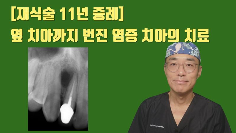 [오래 쓰는 자연 치아] 앞니 재식술 11년 경과 증례를 소개합니다 #재식술 #치아살리기 #최용훈원장