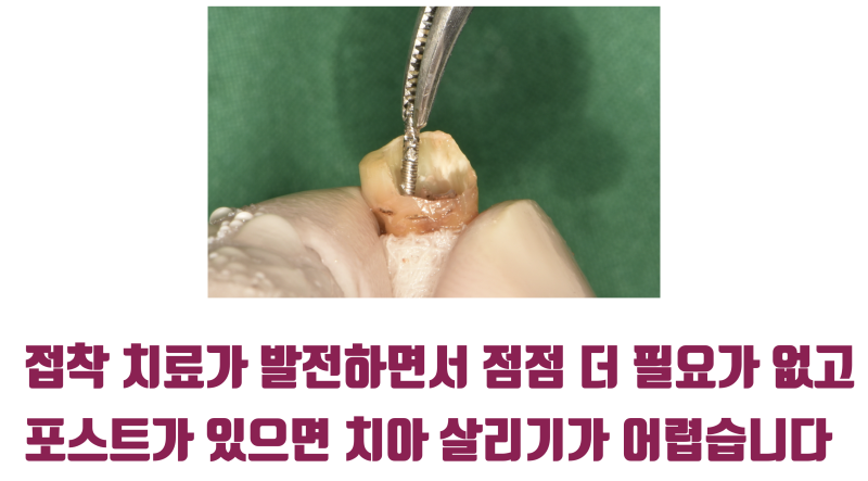 [솔직한 생각] 치아 기둥(Post) 세우기 전에 한 번 생각해 보세요 #치아살리기 #최용훈원장
