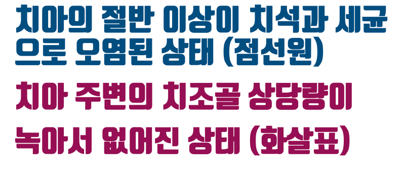 [치아 재생술] 현실적인 치조골 재생 + 치아 살리기 #재식술 #치근단수술 #최용훈원장 사진 3