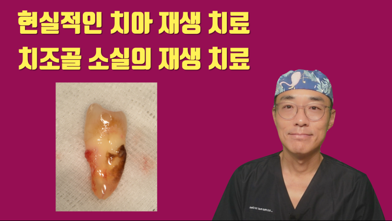[치아 재생술] 현실적인 치조골 재생 + 치아 살리기 #재식술 #치근단수술 #최용훈원장