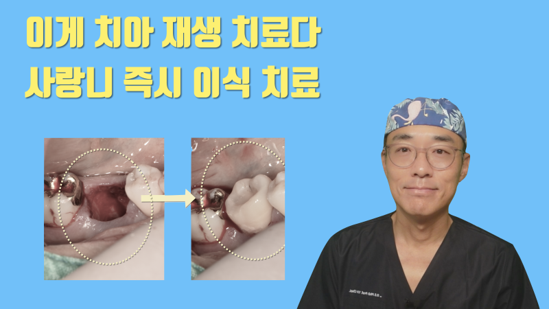 [치아 재생의 실제] 지금 당장 할 수 있는 사랑니 이식 치아 재생술 #재식술 #사랑니이식 #치아이식
