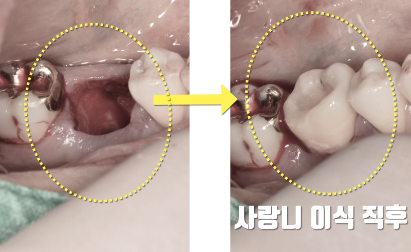 [치아 재생의 실제] 지금 당장 할 수 있는 사랑니 이식 치아 재생술 #재식술 #사랑니이식 #치아이식 사진 3