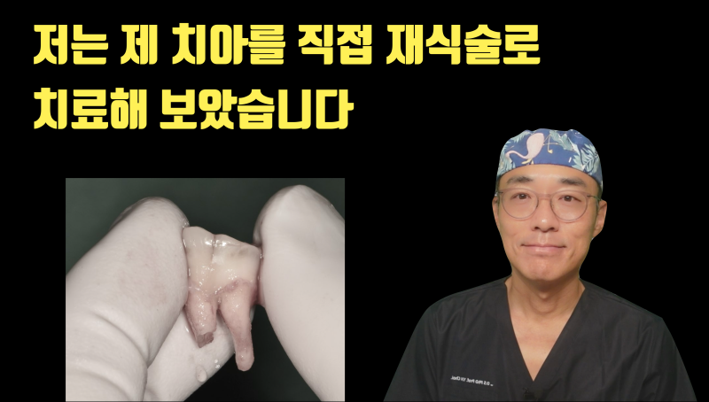 치과 의사가 자기 치아를 재식술로 치료한 후기 (반전 사건 있음) #재식술 #최용훈원장