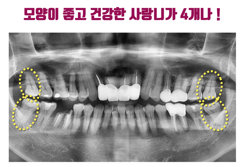 치과에서 부모님께 감사하다고, 사랑한다고 말하라고 하는 이유 #재식술 #최용훈원장