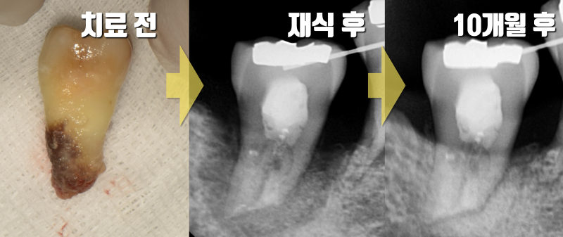 [자체선정] 2025년 치아 살리기 최고의 증례 #재식술 #최용훈원장 #치아살리기