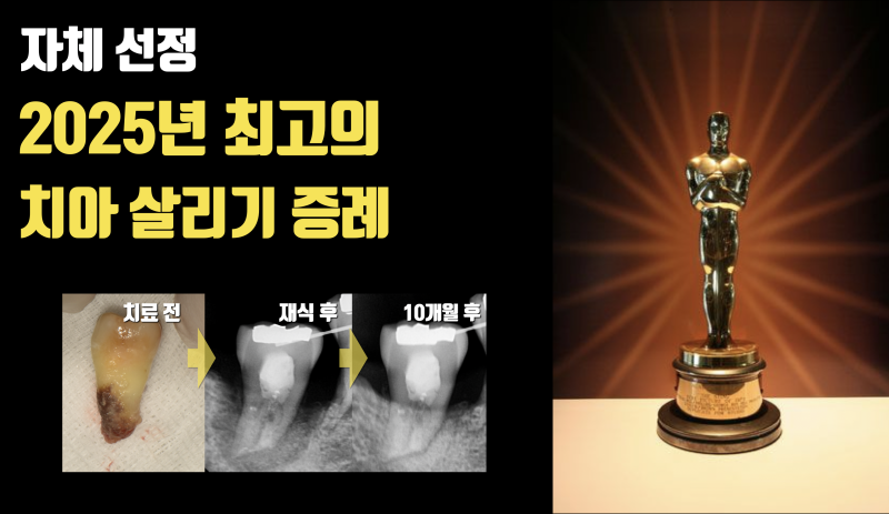 [자체선정] 2025년 치아 살리기 최고의 증례 #재식술 #최용훈원장 #치아살리기