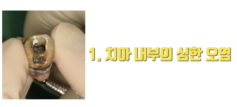 재식술 하라는 말이 아닙니다 지금 받는 치료가 끝이 없는 이유 4가지입니다 #재식술 #최용훈원장 #치아살리기 사진 2