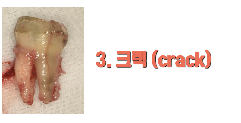 재식술 하라는 말이 아닙니다 지금 받는 치료가 끝이 없는 이유 4가지입니다 #재식술 #최용훈원장 #치아살리기 사진 4
