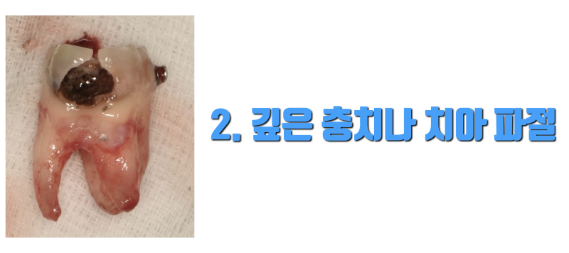 재식술 하라는 말이 아닙니다 지금 받는 치료가 끝이 없는 이유 4가지입니다 #재식술 #최용훈원장 #치아살리기 사진 3