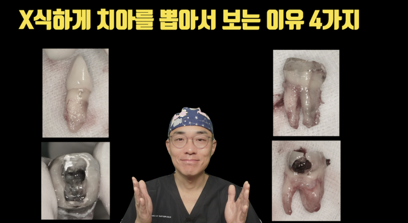 재식술 하라는 말이 아닙니다 지금 받는 치료가 끝이 없는 이유 4가지입니다 #재식술 #최용훈원장 #치아살리기