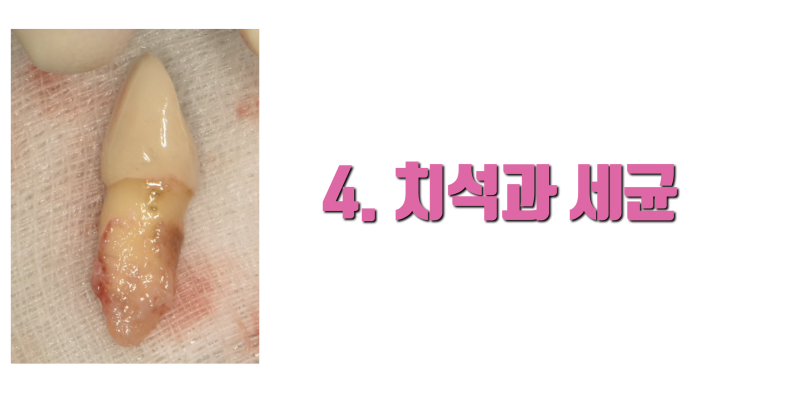 재식술 하라는 말이 아닙니다 지금 받는 치료가 끝이 없는 이유 4가지입니다 #재식술 #최용훈원장 #치아살리기