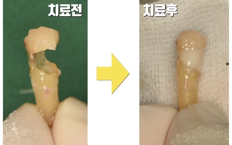 [마지막 잎새, 마지막 치아] 누군가에게는 생명이 달린 치아 이야기 #재식술 #치아살리기 #최용훈원장 사진 3