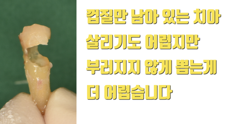 [마지막 잎새, 마지막 치아] 누군가에게는 생명이 달린 치아 이야기 #재식술 #치아살리기 #최용훈원장