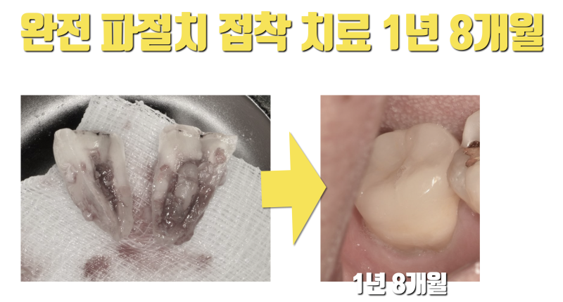 [대한민국 유일] 완전 파절 치아의 접착 재식술 증례 #재식술 #최용훈원장 #치아살리기