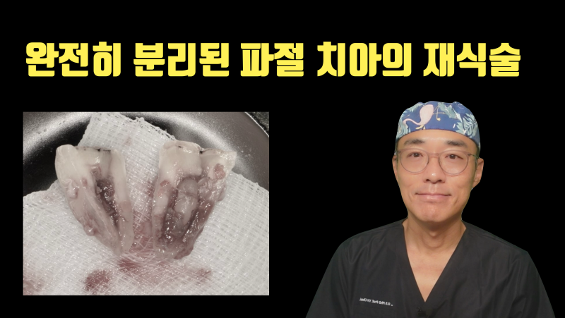 [대한민국 유일] 완전 파절 치아의 접착 재식술 증례 #재식술 #최용훈원장 #치아살리기