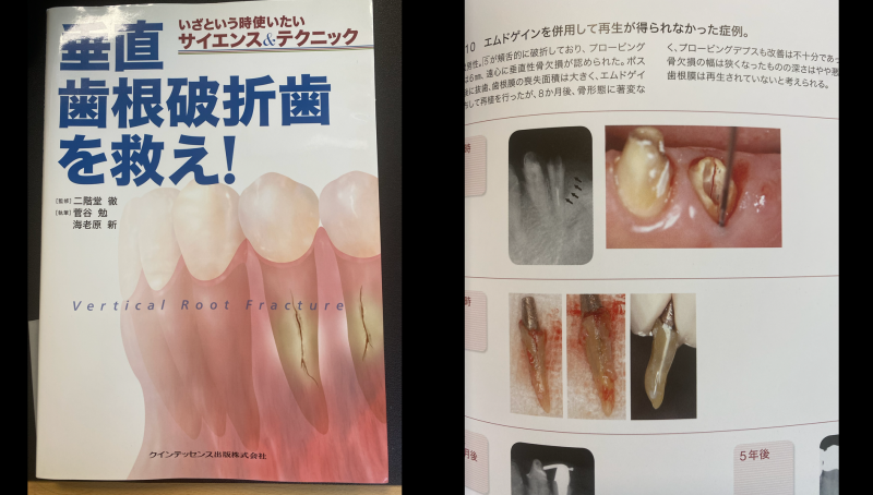 치료 불가 크렉 치아의 현실적 치료법 2가지 #재식술 #치아살리기 #최용훈원장