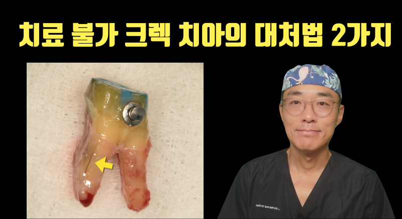 치료 불가 크렉 치아의 현실적 치료법 2가지 #재식술 #치아살리기 #최용훈원장