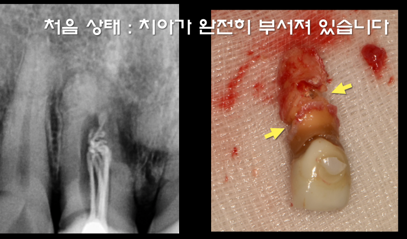 완전히 부서진 치아를 살려서 보철까지 예쁘게 #마이스터치과 #재식술 #치아살리기