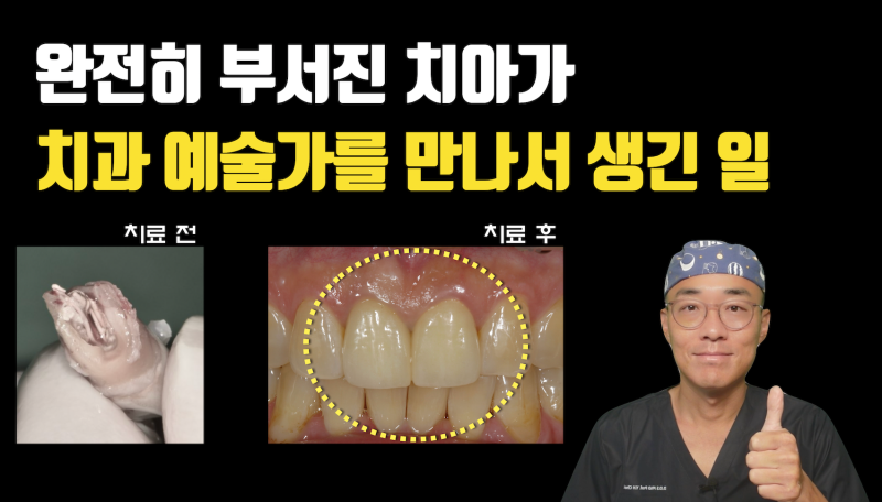 완전히 부서진 치아를 살려서 보철까지 예쁘게 #마이스터치과 #재식술 #치아살리기