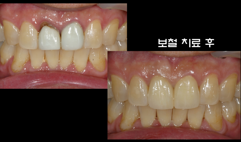 완전히 부서진 치아를 살려서 보철까지 예쁘게 #마이스터치과 #재식술 #치아살리기 사진 5