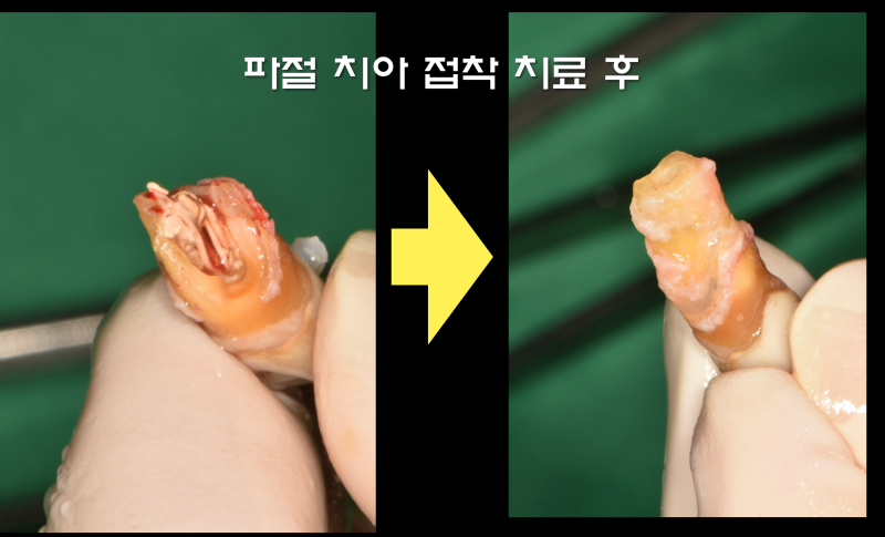 완전히 부서진 치아를 살려서 보철까지 예쁘게 #마이스터치과 #재식술 #치아살리기 사진 3