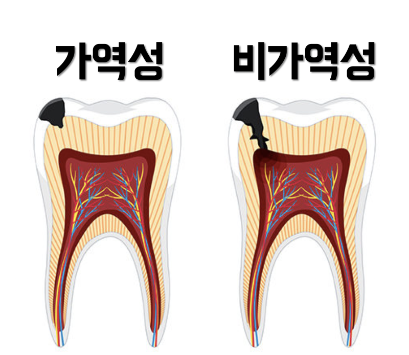 같은 충치인데 가는곳마다 말이 다른 이유와 해결 방법 #재식술 #치아살리기 #최용훈원장