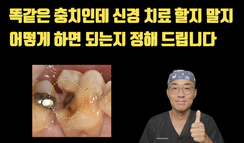 같은 충치인데 가는곳마다 말이 다른 이유와 해결 방법 #재식술 #치아살리기 #최용훈원장