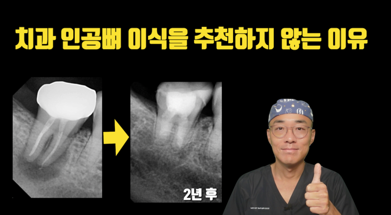 인공 뼈이식보다 자연 치아의 치조골 재생 능력이 더 좋다 #재식술 #치아살리기 #최용훈원장