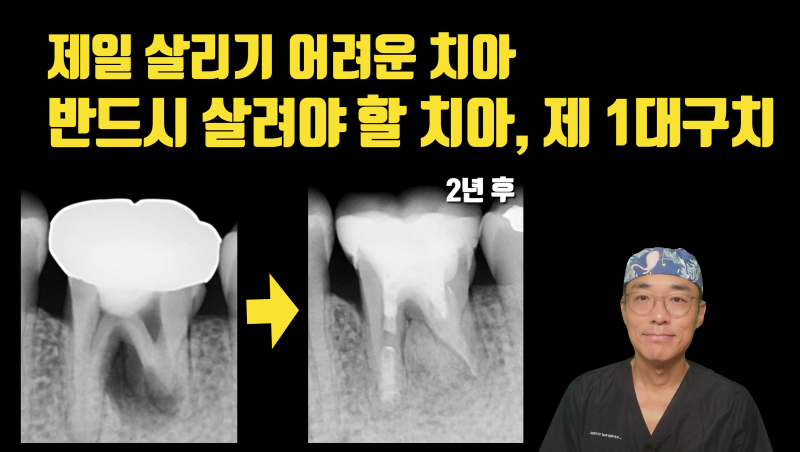 반드시 살려야 하는 제 1대구치 #재식술 #치아살리기 #최용훈원장