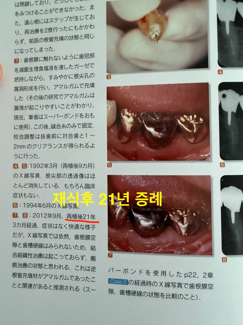 재식술, 이식술 교과서 구하러 일본에 다녀와서 사진 6
