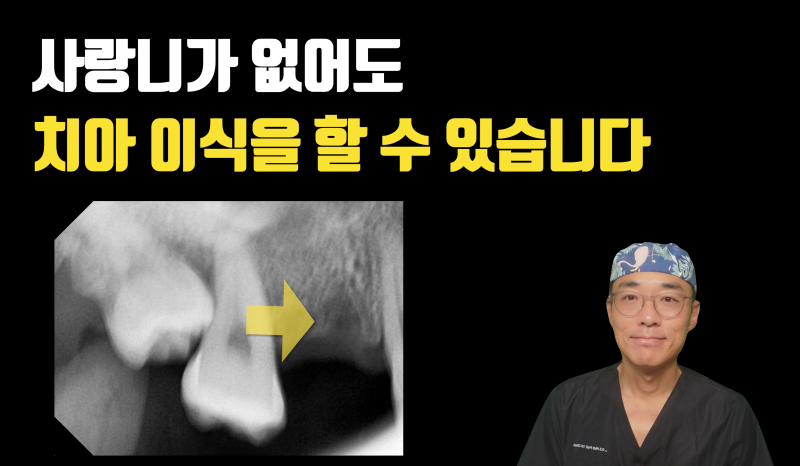 골치 아픈 사랑니의 변신, 사랑니가 없어도 치아 이식술을 할 수 있다 ! #치아이식술 #치아재식술 #최용훈원장